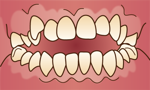 大人の開咬（オープンバイト）の治療について | 世田谷区野沢の矯正歯科｜しぶたに矯正歯科