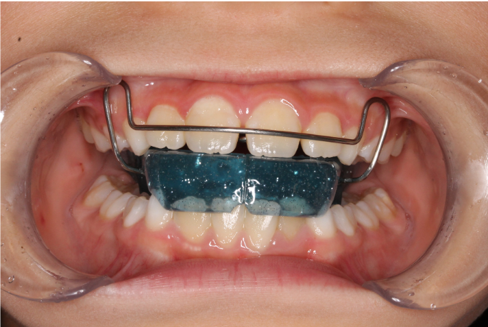 子供の過蓋咬合（噛み合わせが深い）の治療について | 世田谷区野沢の矯正歯科｜しぶたに矯正歯科