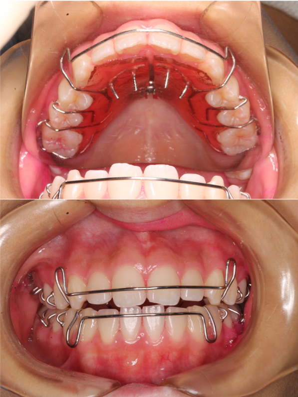 子供の開咬 オープンバイト の治療について 世田谷区野沢の矯正歯科 しぶたに矯正歯科